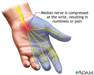carpal-tunnel-syndrome-picture